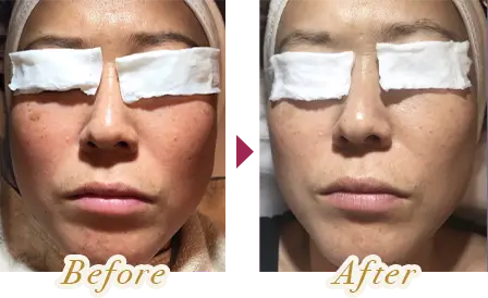 E-lightでフェイシャルエステを受けた女性のビフォーアフター