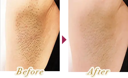 ワキの脱毛を受けた女性のビフォーアフター