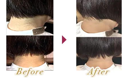 うなじの脱毛を受けた女性のビフォーアフター