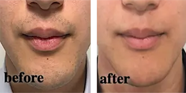 ヒゲ脱毛をした男性のビフォーアフター写真